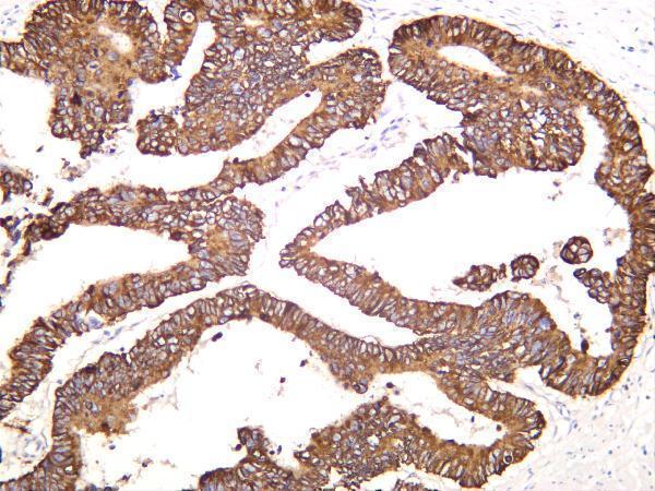 Human colon carcinoma was stained with anti-Cytokeratin 8 rabbit antibody