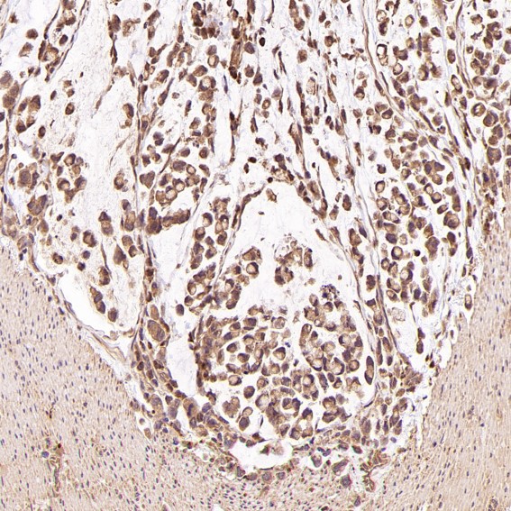 Immunohistochemical analysis of paraffin-embedded Human stomach cancer, using the Antibody at 1:50 dilution