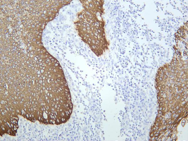 Human cervical squamous cell carcinoma was stained with anti-Cytokeratin 14 rabbit antibody