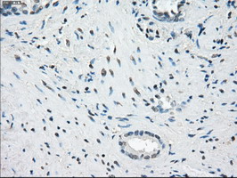 Immunohistochemical staining of paraffin-embedded Carcinoma of Human prostate tissue using anti-FCGR2A mouse monoclonal antibody