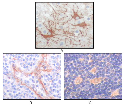 Immunohistochemistry analysis of paraffin-embedded human cerebrum tumor (A), endothelium of vessel (B), lymphocyte of thymus (C), showing cytoplasmic localization with DAB staining using Fes Monoclonal Antibody