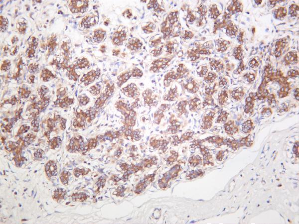 Human breast carcinoma was stained with anti-Met rabbit antibody
