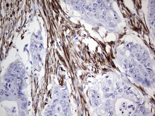 Immunohistochemical staining of paraffin-embedded Adenocarcinoma of Human colon tissue using anti-NR0B1 mouse monoclonal antibody
