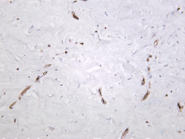 Human breast carcinoma was stained with Anti-FABP4 rabbit antibody