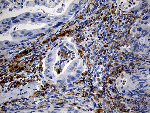 Immunohistochemical staining of paraffin-embedded Carcinoma of Human spleen tissue within the normal limits using anti-TLR8 mouse monoclonal antibody