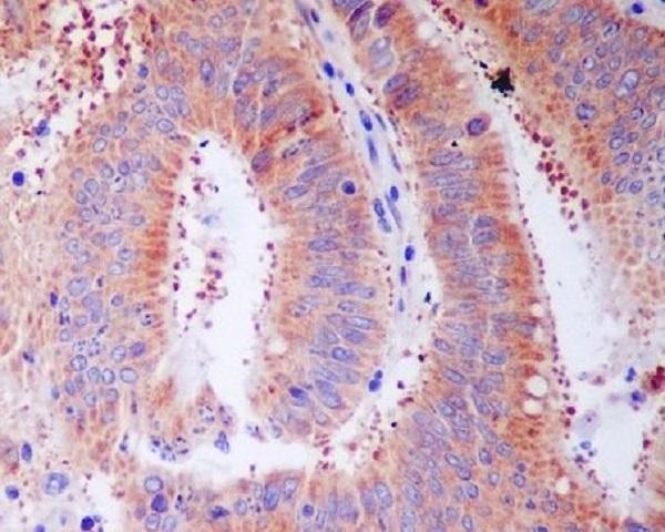 Immunohistochemical analysis of paraffin-embedded human colon cancer, using RPS3 Antibody