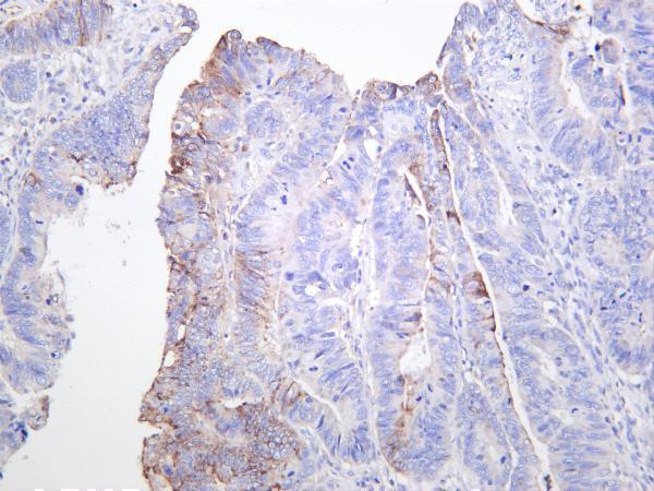 Human colon carcinoma was stained with anti-MMP7 rabbit antibody