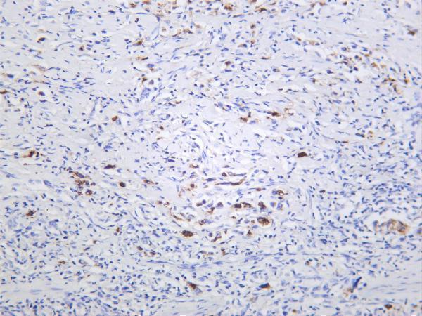 Human gastric carcinoma was stained with anti-MMP7 rabbit antibody