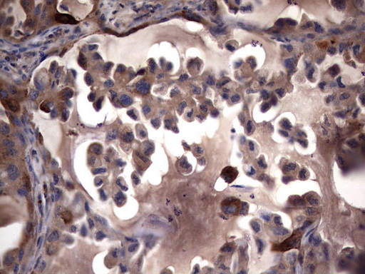 Immunohistochemical staining of paraffin-embedded Carcinoma of Human lung tissue using anti-MMP7 mouse monoclonal antibody