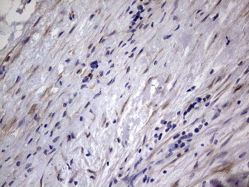 Immunohistochemical staining of paraffin-embedded Adenocarcinoma of Human ovary tissue using anti-MMP7 mouse monoclonal antibody