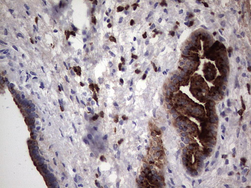 Immunohistochemical staining of paraffin-embedded Carcinoma of Human pancreas tissue using anti-MMP7 mouse monoclonal antibody
