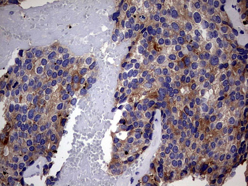 Immunohistochemical staining of paraffin-embedded Adenocarcinoma of Human breast tissue using anti-IRAK2 mouse monoclonal antibody