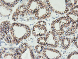 Immunohistochemical staining of paraffin-embedded Carcinoma of Human thyroid tissue using anti-CDH2 mouse monoclonal antibody
