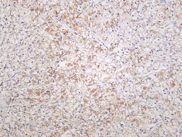 Human kidney carcinoma was stained with anti-N Cadherin rabbit antibody