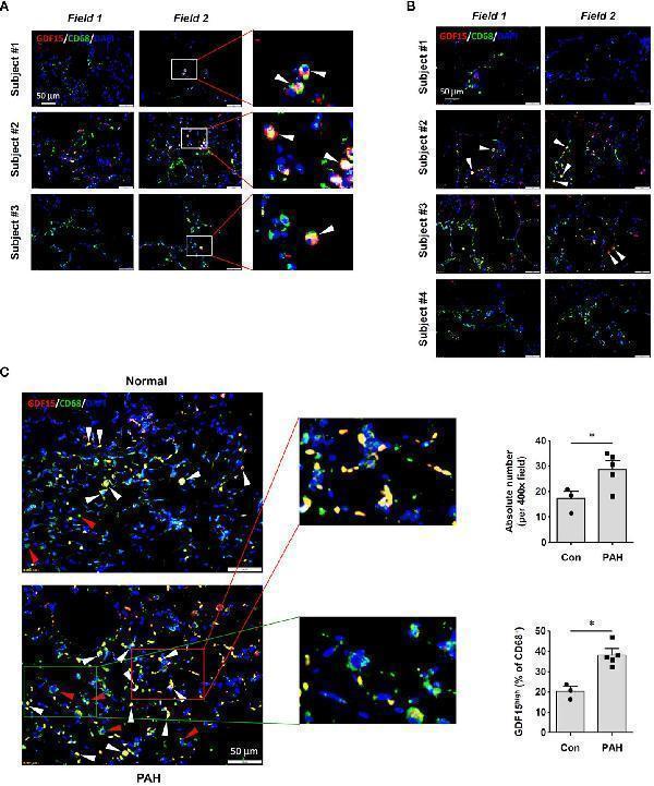 Immunofluorescence double labeling showing the existence of GDF15 high macrophages in lung tissues