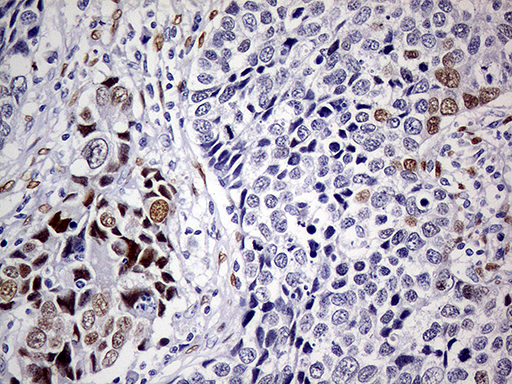 Immunohistochemical staining of paraffin-embedded Carcinoma of Human lung tissue using anti-MEIS1 mouse monoclonal antibody