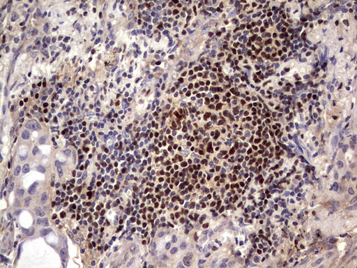 Immunohistochemical staining of paraffin-embedded Carcinoma of Human lung tissue using anti-IKZF3 mouse monoclonal antibody