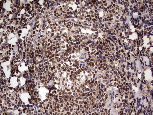 Immunohistochemical staining of paraffin-embedded Human lymphoma tissue using anti-IKZF3 mouse monoclonal antibody