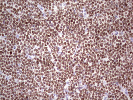 Immunohistochemical staining of paraffin-embedded Human lymphoma tissue using anti-IKZF3 mouse monoclonal antibody