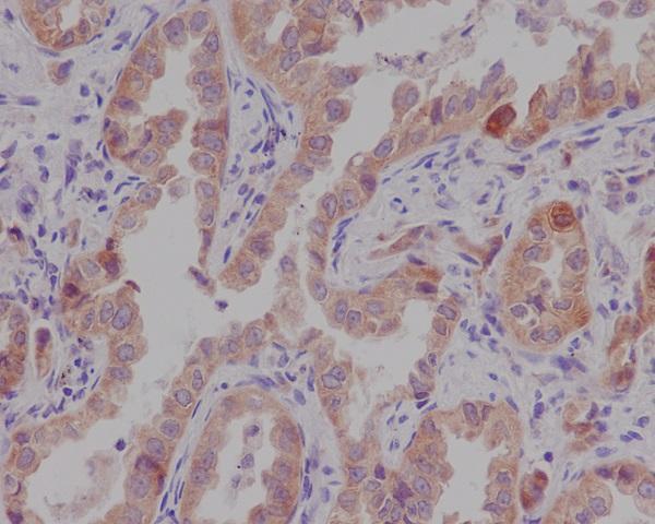 Immunohistochemical analysis of paraffin-embedded human lung cancer, using Catenin alpha 1 Antibody
