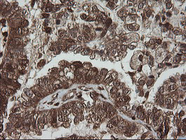 Immunohistochemical staining of paraffin-embedded Adenocarcinoma of Human ovary tissue using anti-PGD mouse monoclonal antibody