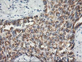 Immunohistochemical staining of paraffin-embedded Carcinoma of Human lung tissue using anti-SNAP25 mouse monoclonal antibody
