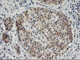 Immunohistochemical staining of paraffin-embedded Carcinoma of Human pancreas tissue using anti-SNAP25 mouse monoclonal antibody