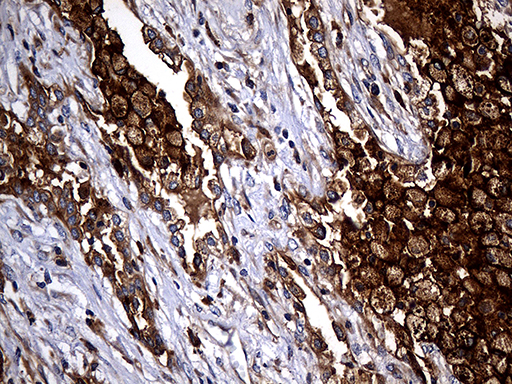 Immunohistochemical staining of paraffin-embedded Carcinoma of Human lung tissue using anti-CPM mouse monoclonal antibody
