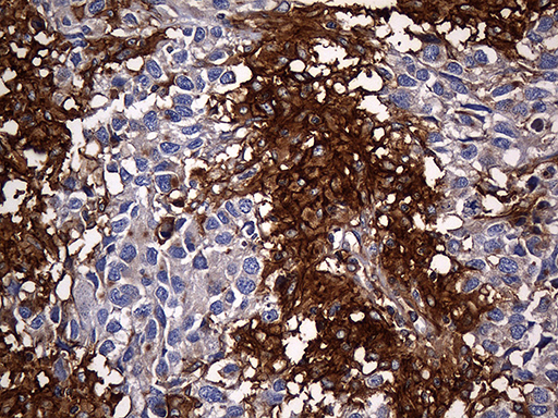 Immunohistochemical staining of paraffin-embedded Adenocarcinoma of Human ovary tissue using anti-CPM mouse monoclonal antibody