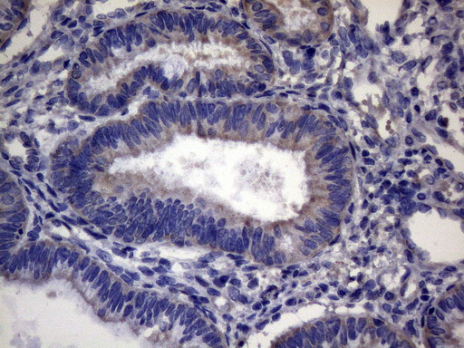 Immunohistochemical staining of paraffin-embedded Adenocarcinoma of Human endometrium tissue using anti-CEP63 mouse monoclonal antibody