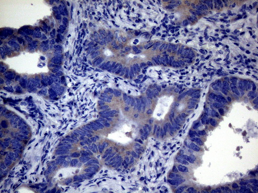 Immunohistochemical staining of paraffin-embedded Adenocarcinoma of Human colon tissue using anti-CEP63 mouse monoclonal antibody