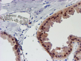 Immunohistochemical staining of paraffin-embedded Human breast tissue within the normal limits using anti-UNG mouse monoclonal antibody