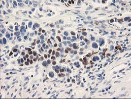 Immunohistochemical staining of paraffin-embedded Carcinoma of Human lung tissue using anti-UNG mouse monoclonal antibody