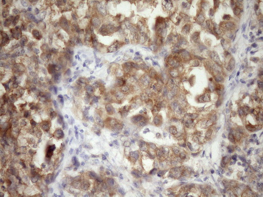 Immunohistochemical staining of paraffin-embedded Adenocarcinoma of Human endometrium tissue using anti-TARBP2 mouse monoclonal antibody