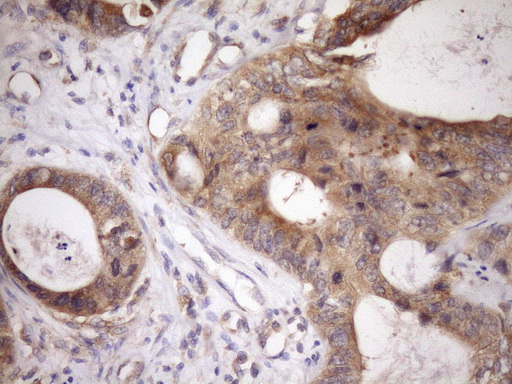 Immunohistochemical staining of paraffin-embedded Adenocarcinoma of Human colon tissue using anti-TARBP2 mouse monoclonal antibody