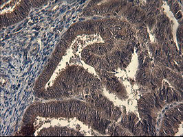 Immunohistochemical staining of paraffin-embedded Adenocarcinoma of Human endometrium tissue using anti-IDO1 mouse monoclonal antibody