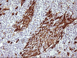Immunohistochemical staining of paraffin-embedded Human lymphoma tissue using anti-IDO1 mouse monoclonal antibody
