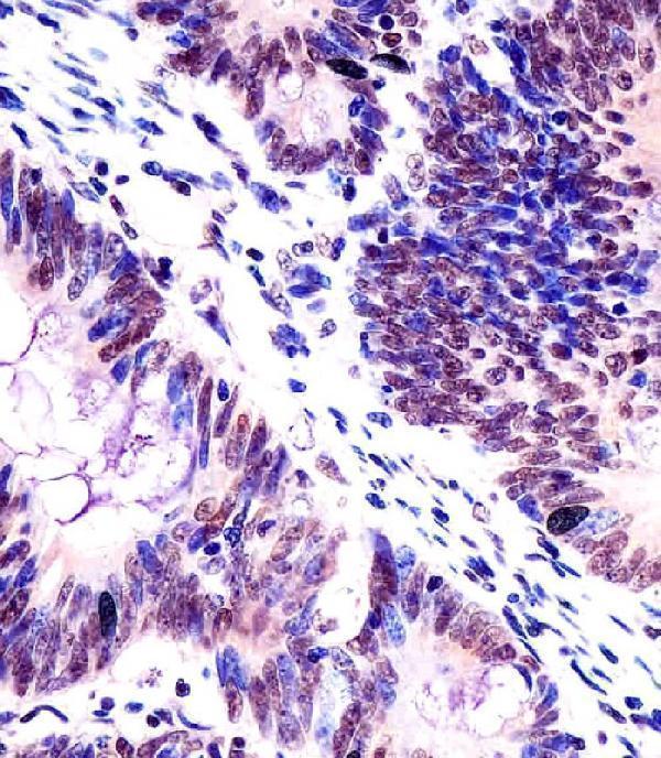 M01717 staining KHDRBS1 in human colorectal carcinoma tissue sections by Immunohistochemistry (IHC-P -paraformaldehyde-fixed, paraffin-embedded sections)
