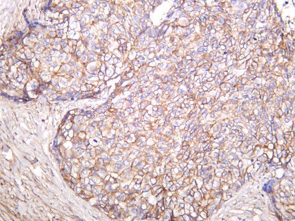 Human prostate carcinoma was stained with anti-CD99 rabbit antibody