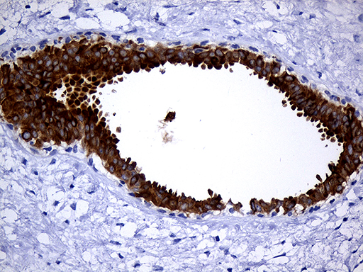 Immunohistochemical staining of paraffin-embedded Human breast tissue within the normal limits using anti-TFF3 mouse monoclonal antibody