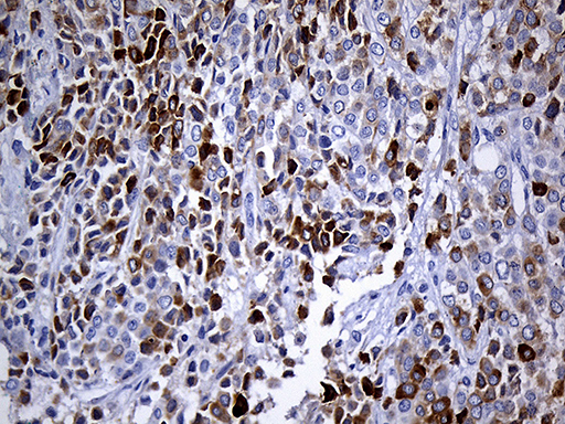 Immunohistochemical staining of paraffin-embedded Adenocarcinoma of Human breast tissue tissue using anti-TFF3 mouse monoclonal antibody