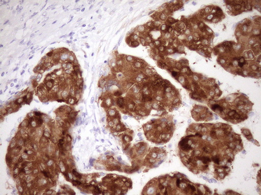 Immunohistochemical staining of paraffin-embedded Carcinoma of Human liver tissue using anti-FMO3 mouse monoclonal antibody