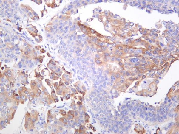 Human bladder carcinoma was stained with anti-Ezrin rabbit antibody