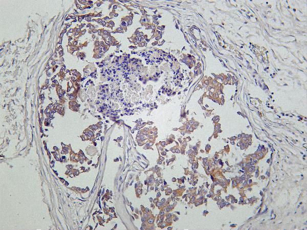 Human breast carcinoma was stained with Anti-ALIX rabbit antibody