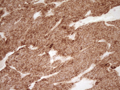 Immunohistochemical staining of paraffin-embedded Carcinoma of Human lung tissue using anti-SFRP2 mouse monoclonal antibody