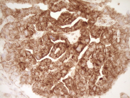 Immunohistochemical staining of paraffin-embedded Adenocarcinoma of Human ovary tissue using anti-SFRP2 mouse monoclonal antibody