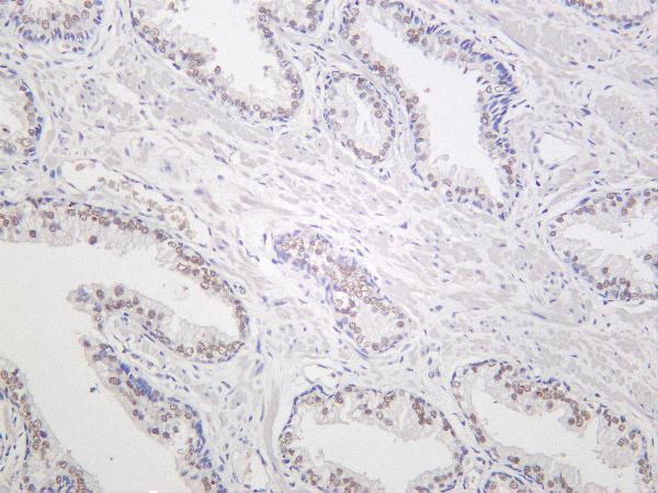 Human prostate cancer was stained with Anti-METTL3 rabbit antibody