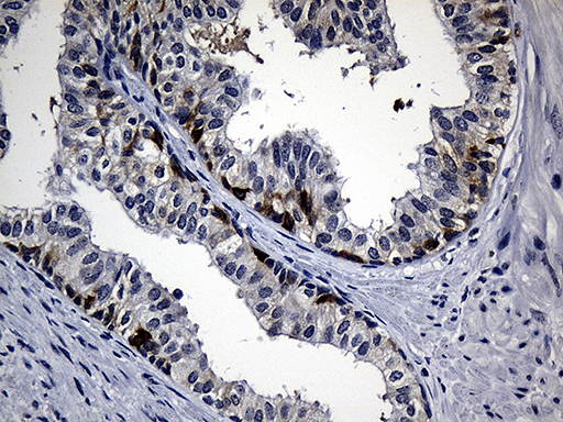 Immunohistochemical staining of paraffin-embedded Carcinoma of Human prostate tissue using anti-RRM1 mouse monoclonal antibody