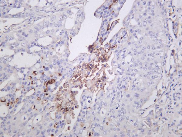 Human bladder carcinoma was stained with anti-CD133 rabbit antibody