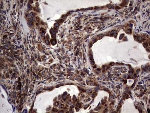 Immunohistochemical staining of paraffin-embedded Carcinoma of Human lung tissue using anti-DOCK8 mouse monoclonal antibody